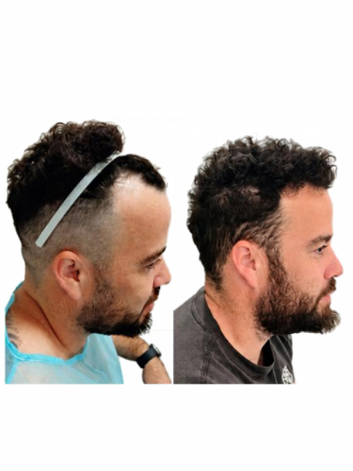 בן לפני ואחרי השתלת שיער בשיטת DHI – מבט מהצד על קו השיער ואזור הרקות
