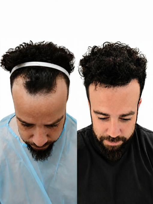 השתלת שיער לפני ואחרי – בן, נסיגת קו שיער קדמי לפני ההשתלה וקו שיער מלא חצי שנה אחרי השתלת DHI