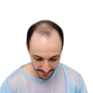 נשירת שיער אצל גבר - דלילות והתקרחות באזור קדמת הראש