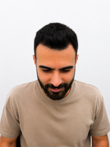 תוצאה טבעית לאחר השתלת שיער לגבר - צפיפות משופרת וקו שיער אחיד