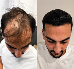 השתלת שיער לפני ואחרי - טיפול בהתקרחות ושיפור צפיפות השיער