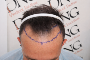 שרטוט קו שיער לפני השתלת שיער בהתאמה אישית למבנה הפנים