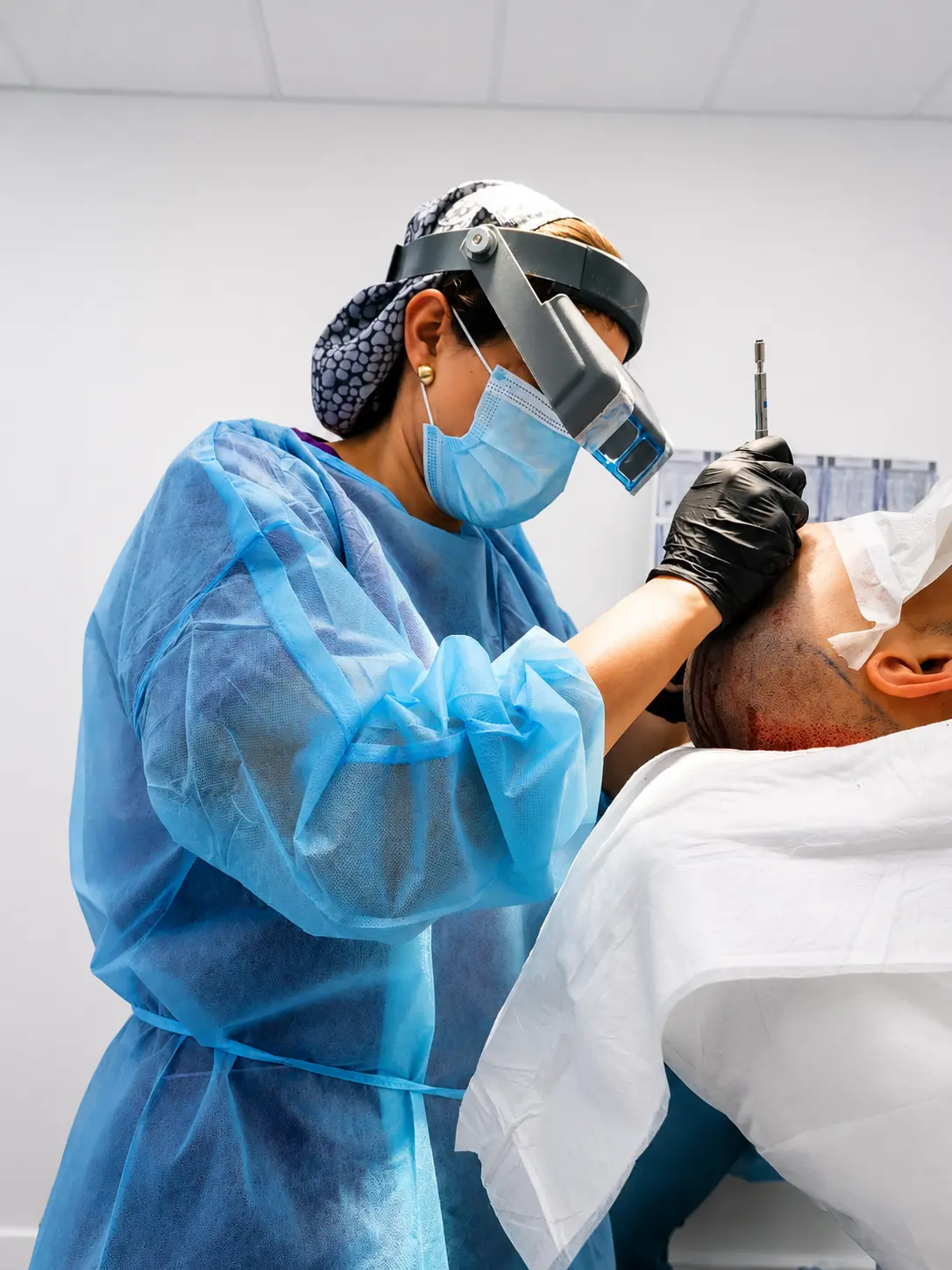השתלת שיער בשיטת FUE במרפאת DNG Medical
