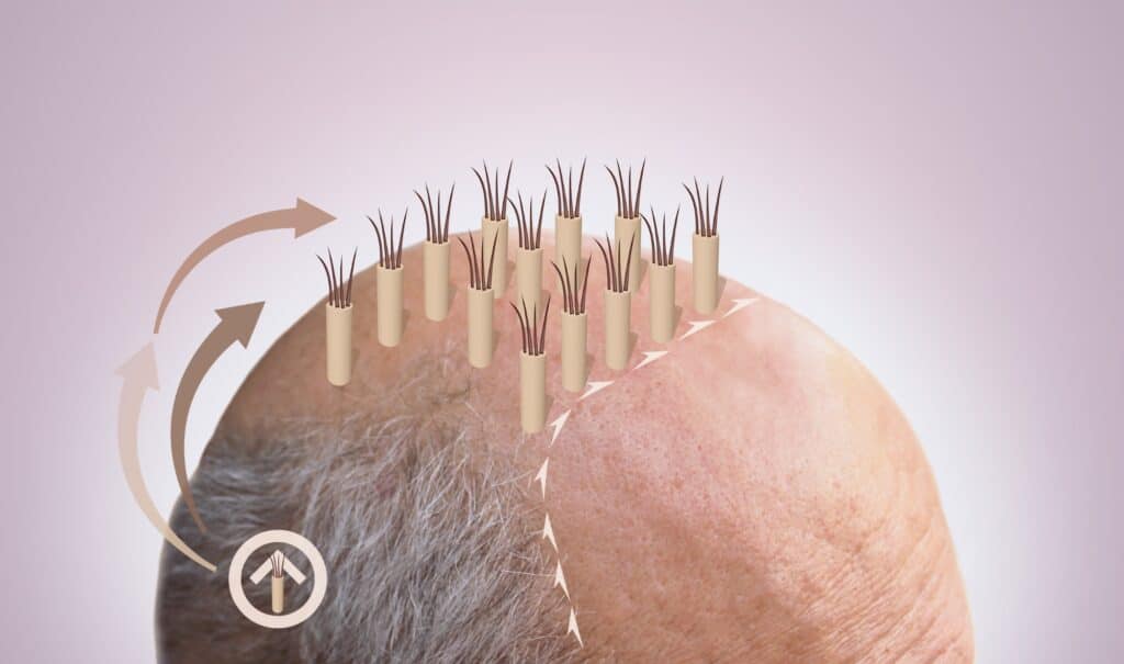FUE Hair Transplant