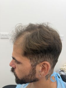 דלילות שיער חזקה לפני השתלת שיער