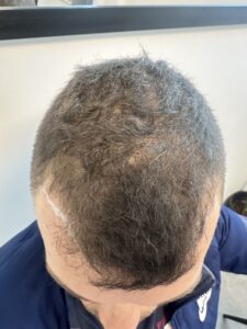 תכנון ושרטוט לפני תהליך השתלת שיער