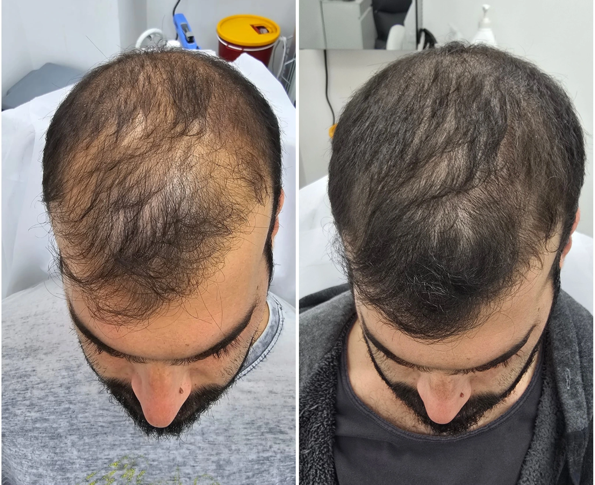 לפני ואחרי טיפול PRF ו-IPRF לשיער - שיפור צפיפות השיער והפחתת נשירה