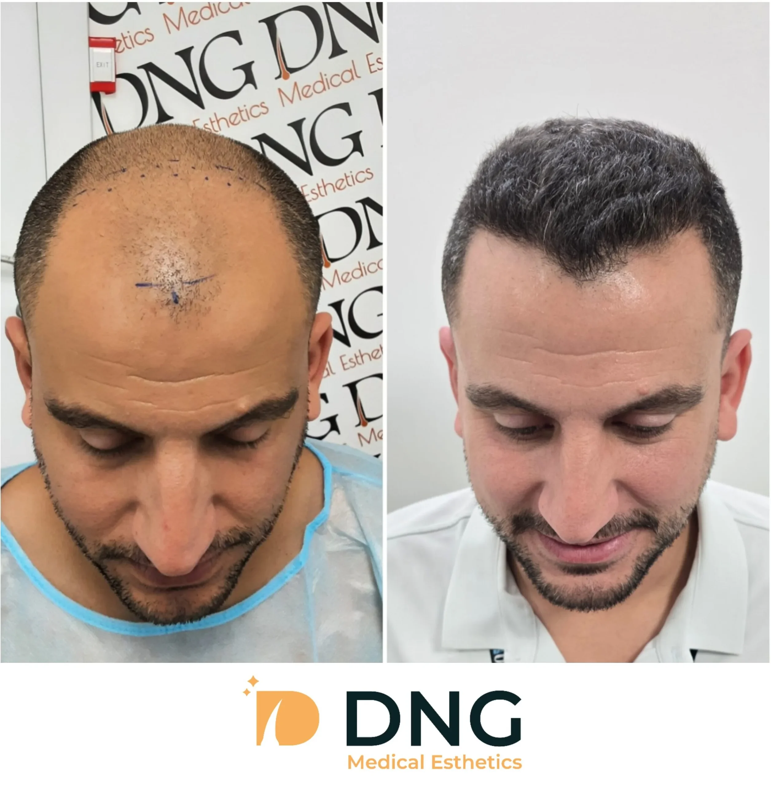 תוצאות השתלת שיער לגברים לפני ואחרי