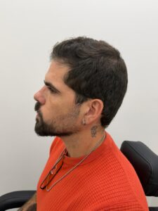 תוצאות השתלת שיער מזווית פרופיל - צפיפות טבעית