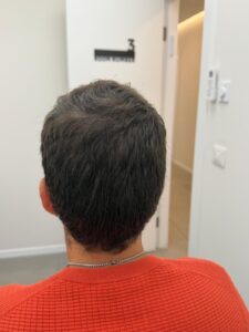 תהליך השתלת שיער DHI ו-FUE במרפאת DNG Medical Esthetics