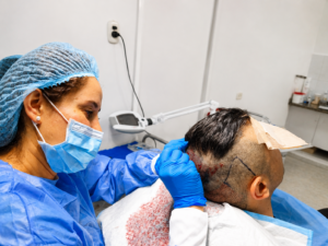 הוצאת זקיקי שיער בשיטת FUE בקליניקת DNG Medical