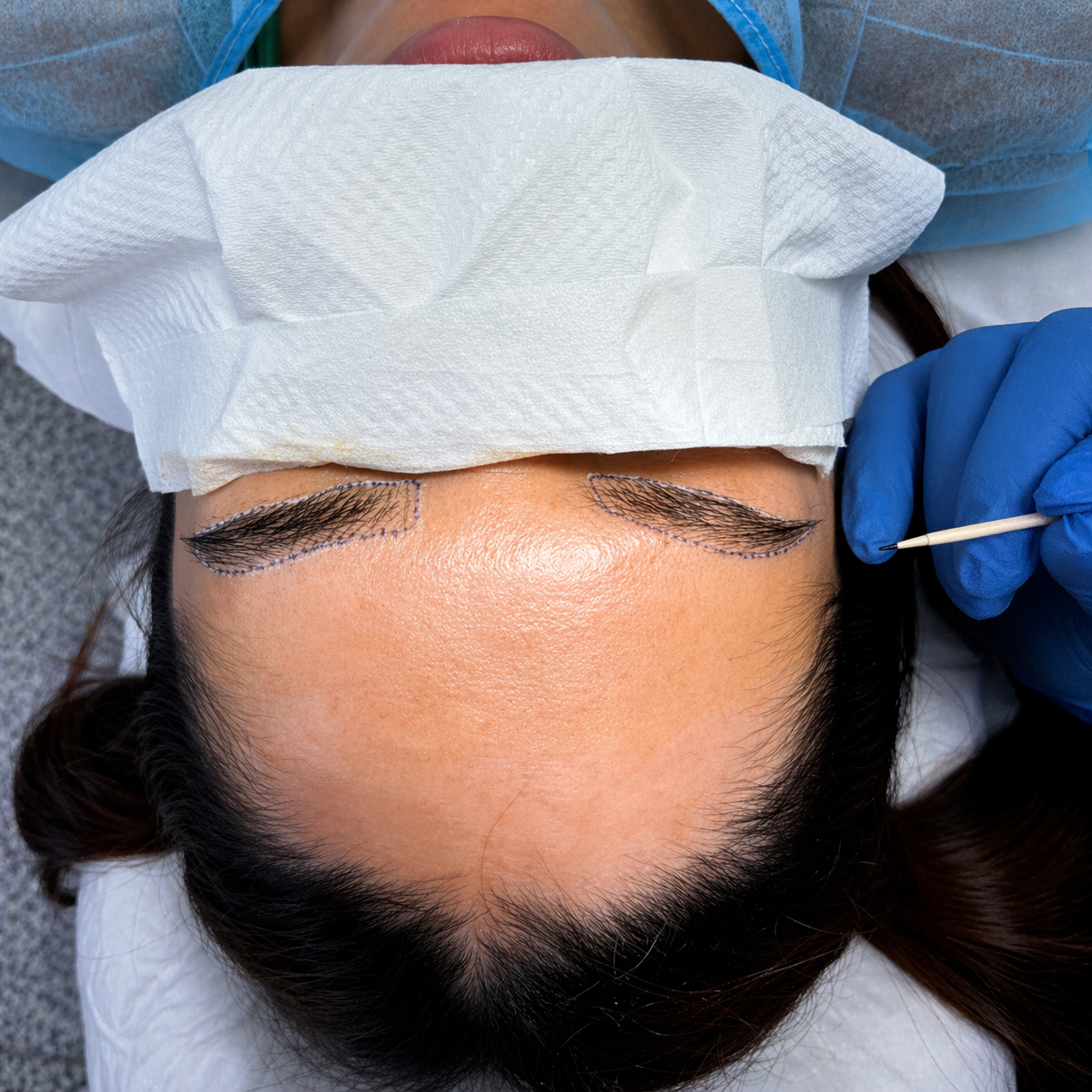 סימון גבות לפני השתלת גבות בשיטת DHI