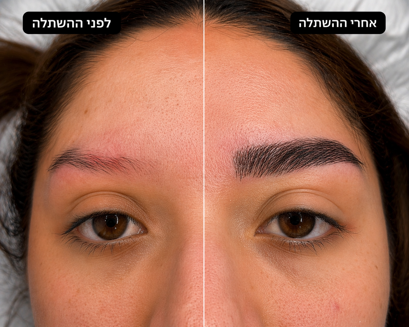 השתלת גבות לפני ואחרי - תוצאה טבעית של עיבוי גבות בשיטת DHI