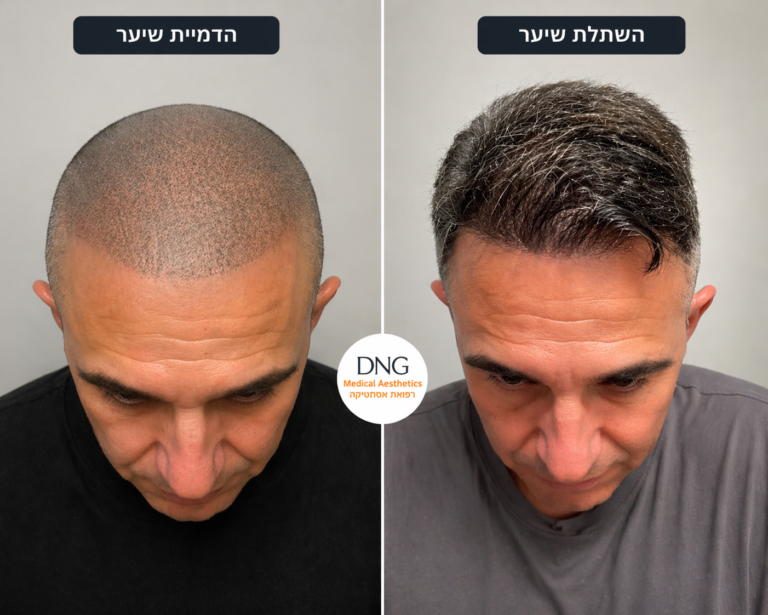 השוואה בין הדמיית שיער להשתלת שיער – תוצאה לפני ואחרי