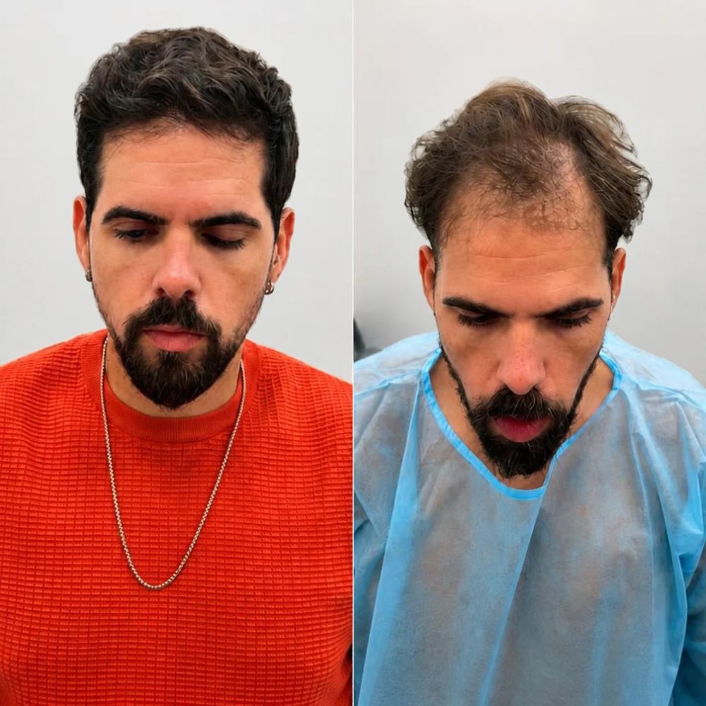 השתלת שיער לפני ואחרי - אופק, בן 30, נסיגת קו שיער קדמי לפני ההשתלה וקו שיער מלא אחריה
