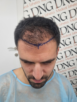 אלמוג לפני השתלת שיער – תכנון וסימון קו השיער הקדמי ודלילות באזור הקדמי