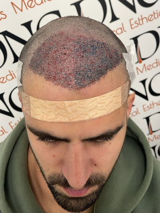 אלמוג מיד אחרי השתלת שיער בשיטת DHI – הזקיקים המושתלים באזור הקדמי