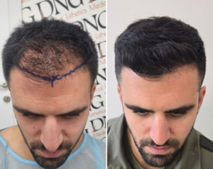 אלמוג לפני ואחרי השתלת שיער – קו שיער קדמי משוקם וצפיפות מלאה, מבט מלפנים