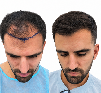 השתלת שיער לפני ואחרי – אלמוג, נסיגת קו שיער קדמי לפני ההשתלה וקו שיער מלא אחרי השתלת DHI