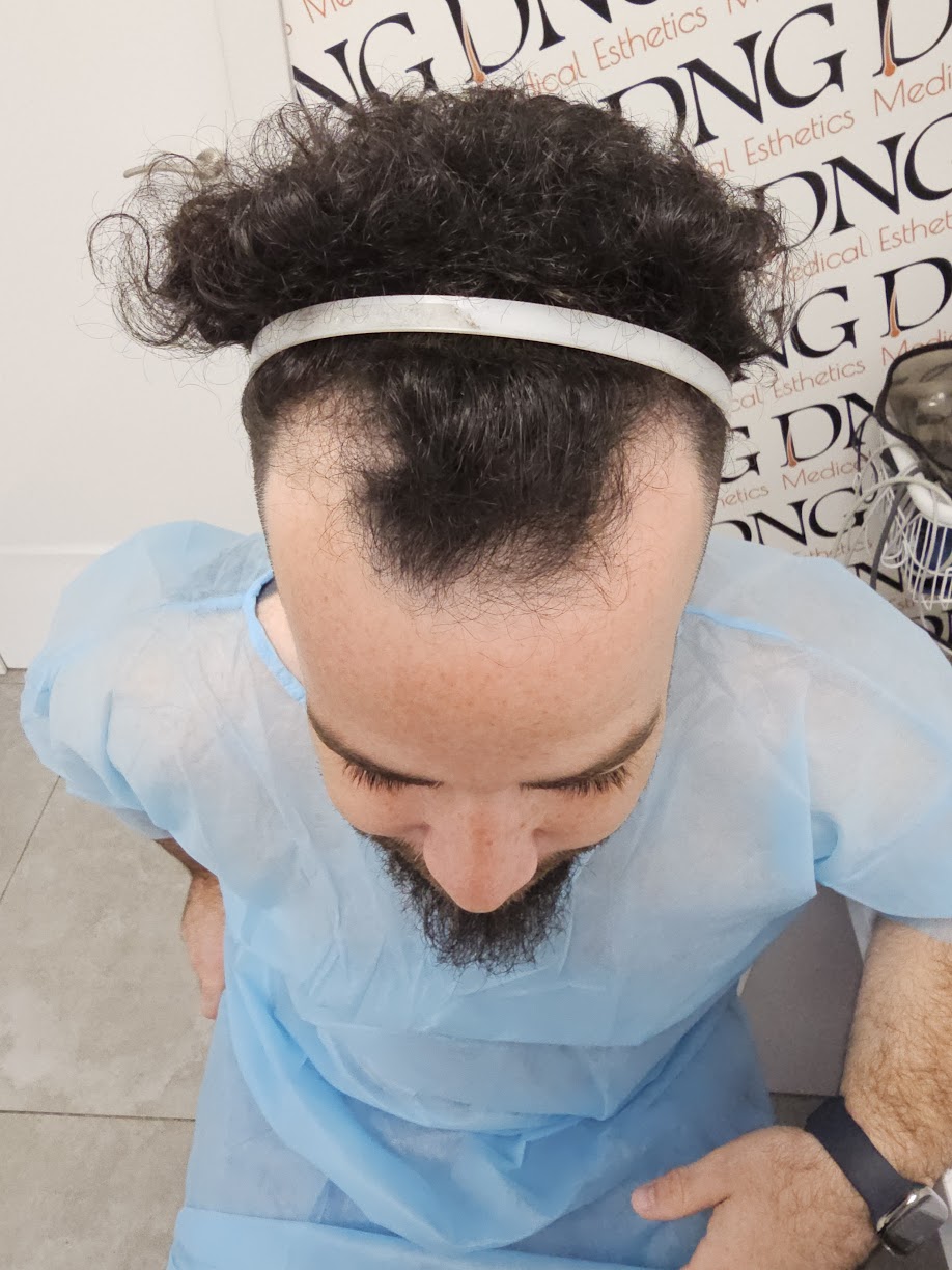 בן ביום השתלת השיער – תכנון וסימון קו השיער הקדמי לפני השתלה בשיטת DHI