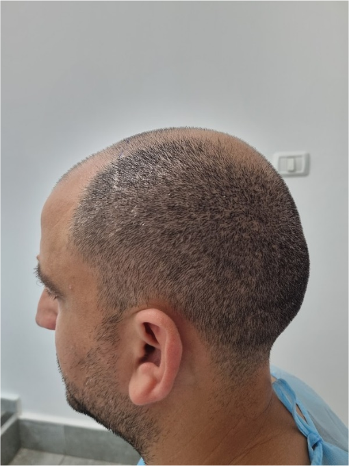 רון לפני השתלת שיער בשיטת FUE – התקרחות ונסיגת קו שיער באזור הקדמי והמרכזי, מבט מהצד