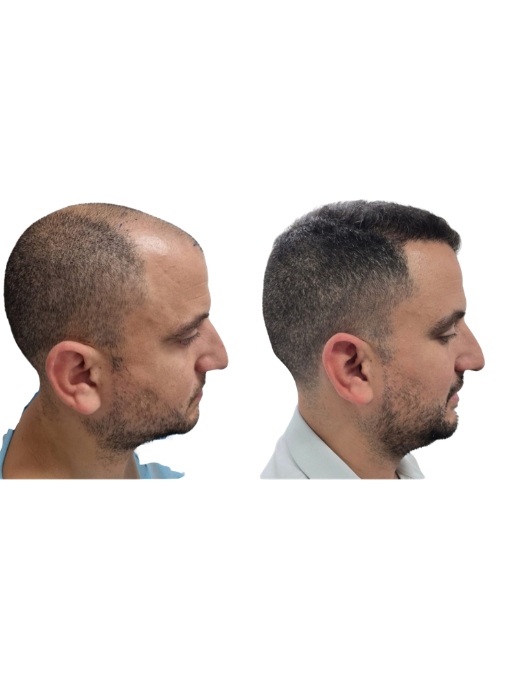 השתלת שיער לפני ואחרי – רון, התקרחות באזור הקדמי והמרכזי לפני ההשתלה ושיער מלא אחרי השתלת FUE