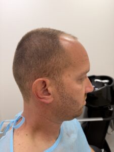 מאור לפני השתלת שיער במרפאת DNG - מבט מהצד על דלילות בקו השיער