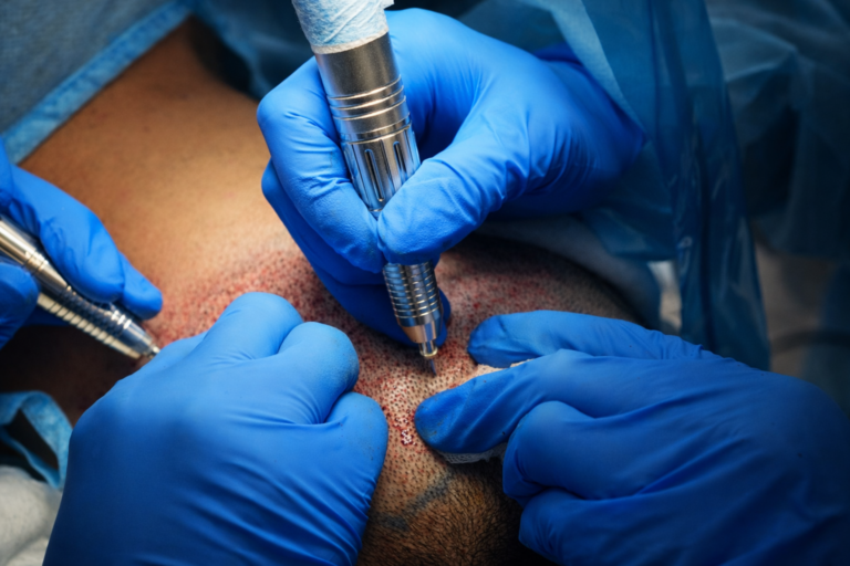 החלמה לאחר השתלת שיער בשיטת DHI עם החדרת זקיקים לקרקפת