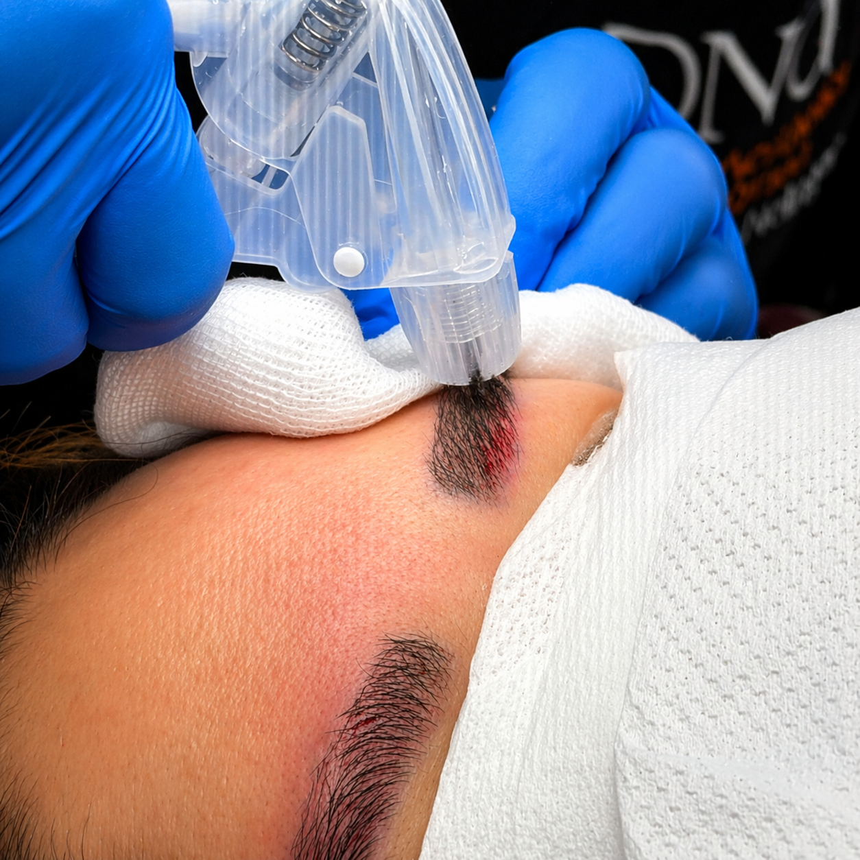 השתלת גבות בשיטת DHI בזמן טיפול מדויק