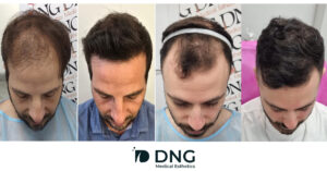 לפני אחרי מילוי פוני