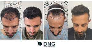  שחזור קו שיער קדמי לפני ואחרי