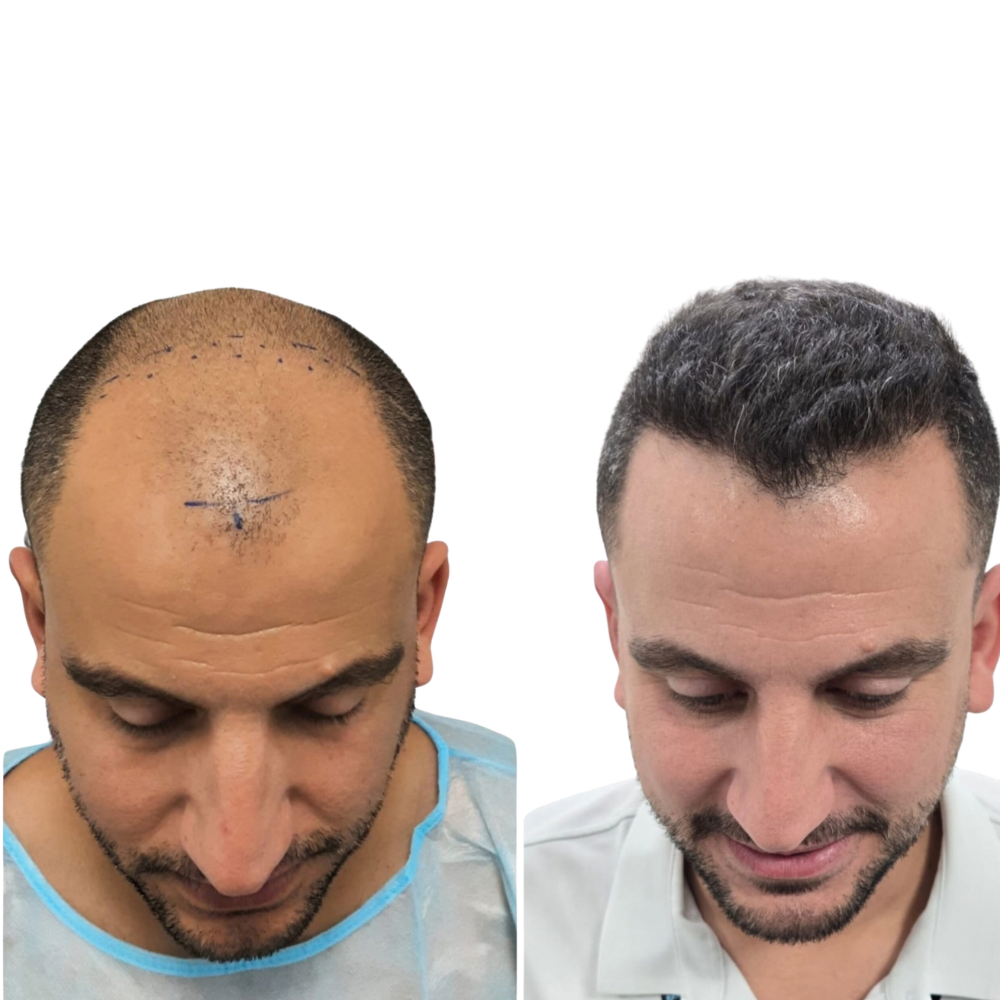 השתלת שיער לפני ואחרי – רון, כ-2,700 זקיקים בשיטת FUE לשחזור קו השיער הקדמי