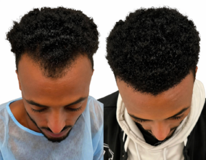 השתלת שיער לפני ואחרי – שיפור בצפיפות השיער ותוצאה טבעית